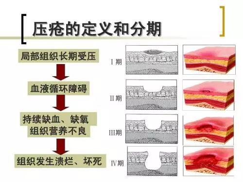 2017年压疮最新分期【2017年压疮分期新标准揭晓】